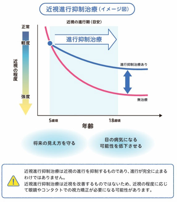 近視進行抑制治療イメージ