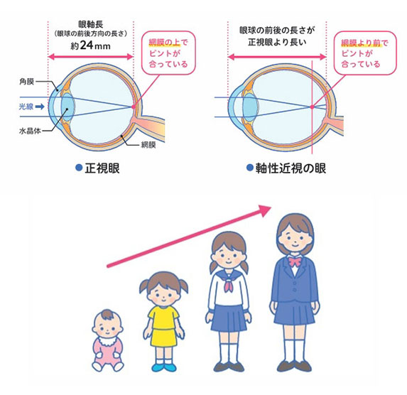 正視眼・軸性近視の眼の比較