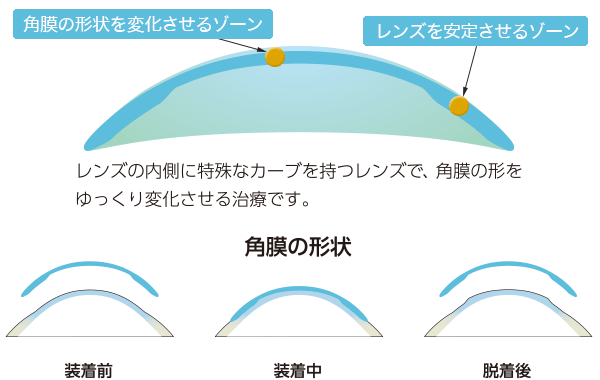角膜の形状の矯正について